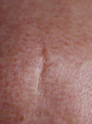 cicatrice.jpg (363.71 Kio) Vu 4878 fois cicatrice.jpg